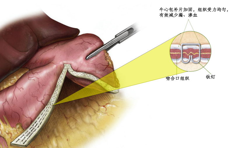 防渗漏，促愈合-尊龙凯时人生就是搏医疗消化外科生物补片注册临床试验入组正式完成