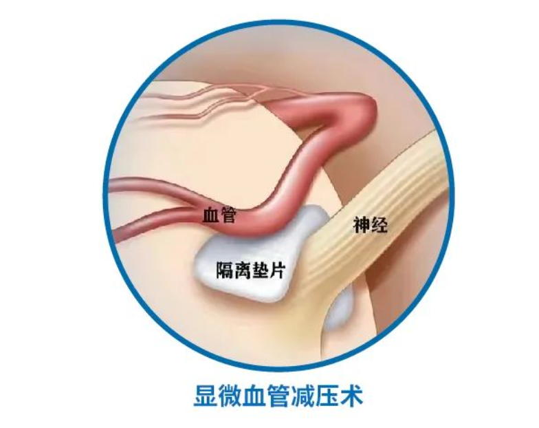 微血管减压术在面肌痉挛患者中的应用